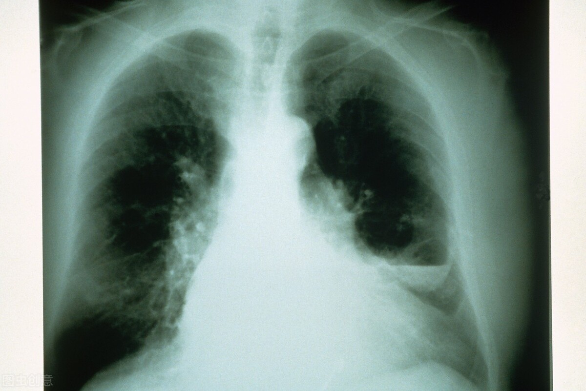 慢性支气管炎急性发作怎么治,慢性支气管炎急性发作期特点是