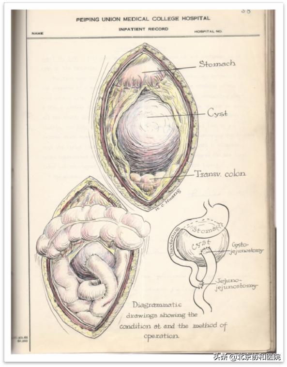 北京协和医院基本外科张太平,北京协和医院张太平手术水平