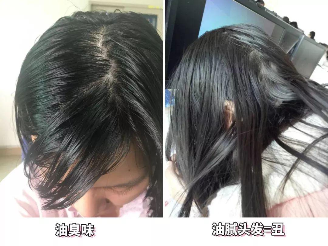 去头屑去螨虫哪个洗发水最有效,去头屑去螨虫用哪个洗发水最有效