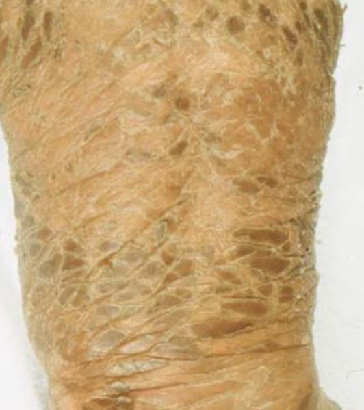 皮肤干燥起皮屑瘙痒吃什么中成药,皮肤干燥发痒掉屑用啥药