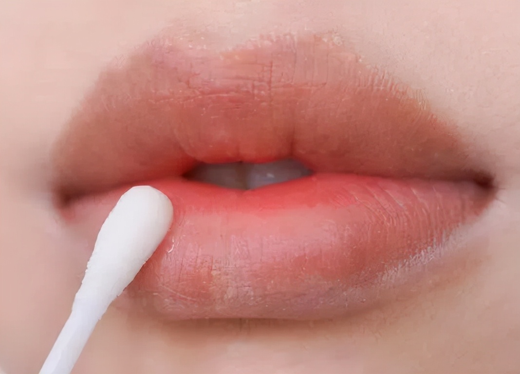鼻孔干燥结痂嘴唇干燥起皮怎么办,嘴唇干燥开裂无法愈合