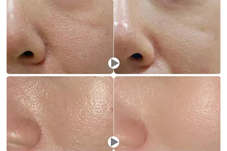 造成毛孔粗大的原因和改善方法,怎样改善毛孔粗大的问题和方法