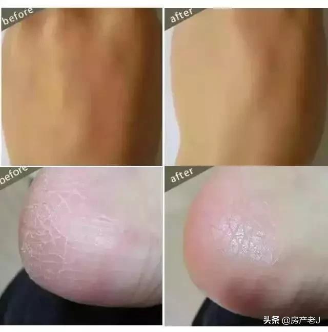 腿上有鱼鳞皮屑怎么办,腿上起皮屑就是鱼鳞病