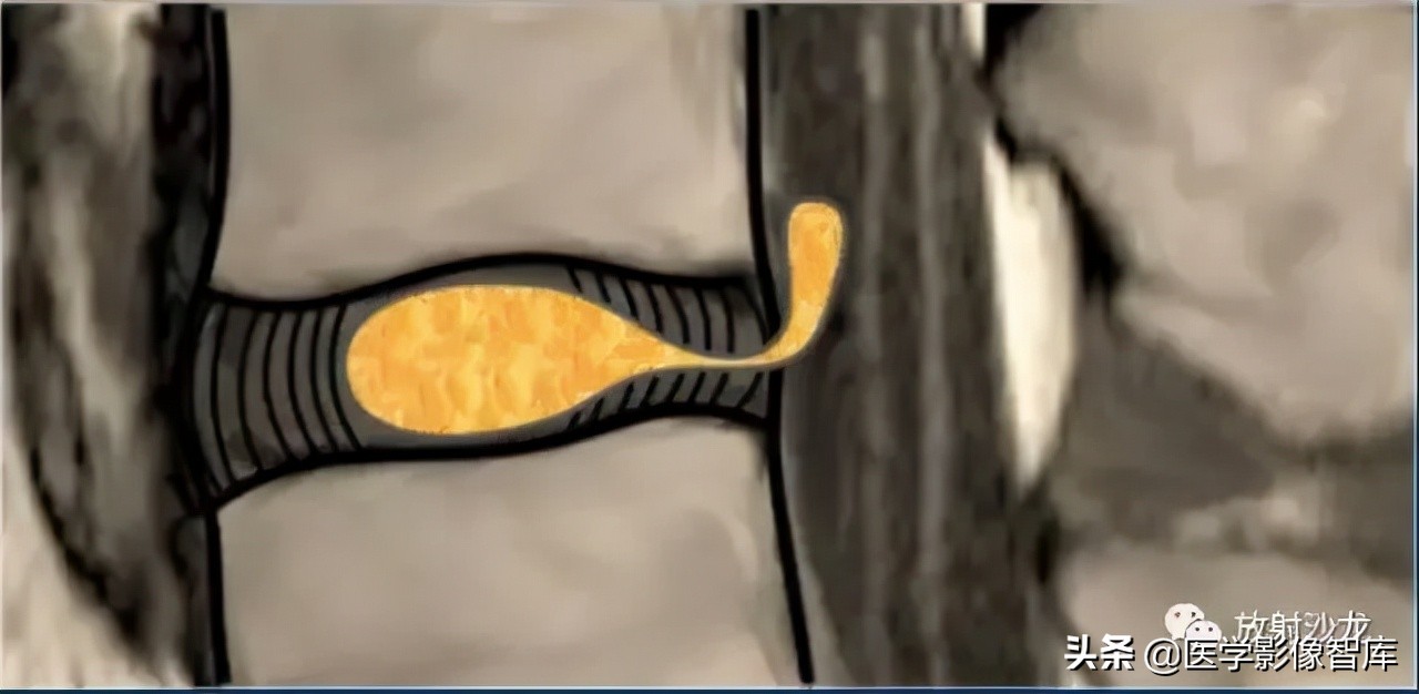 一键收藏所有的内容,颈椎间盘病变的症状和治疗