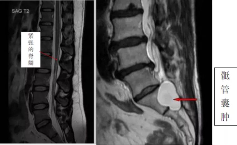 尾椎骨下方屁股两处反复长水泡,尾椎骨附近起了水泡是怎么回事