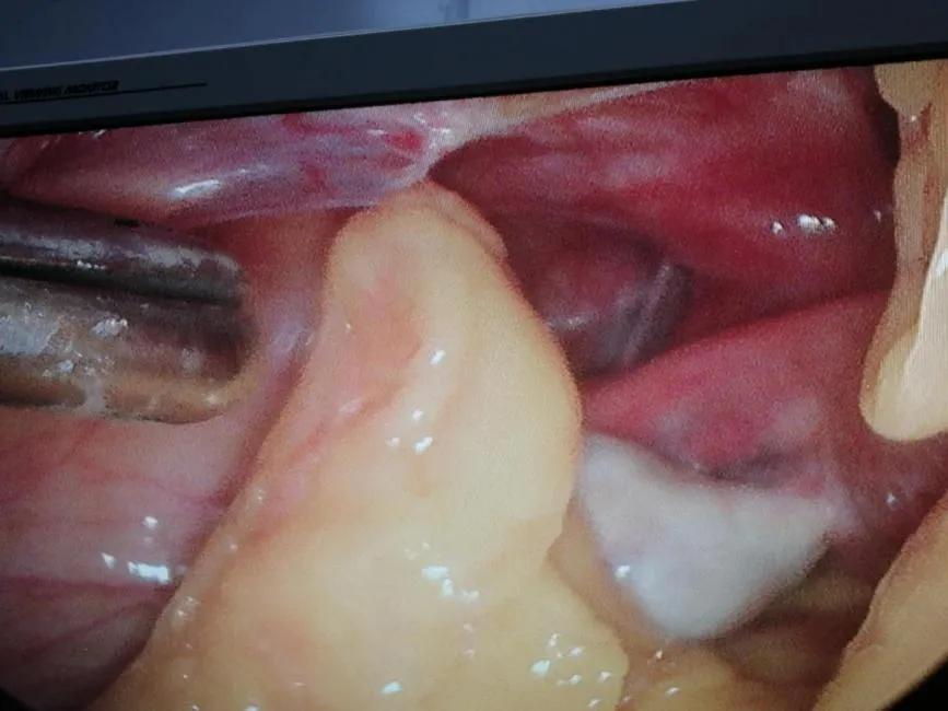 急性盆腔脓肿早期最佳治疗,盆腔脓肿的手术指征