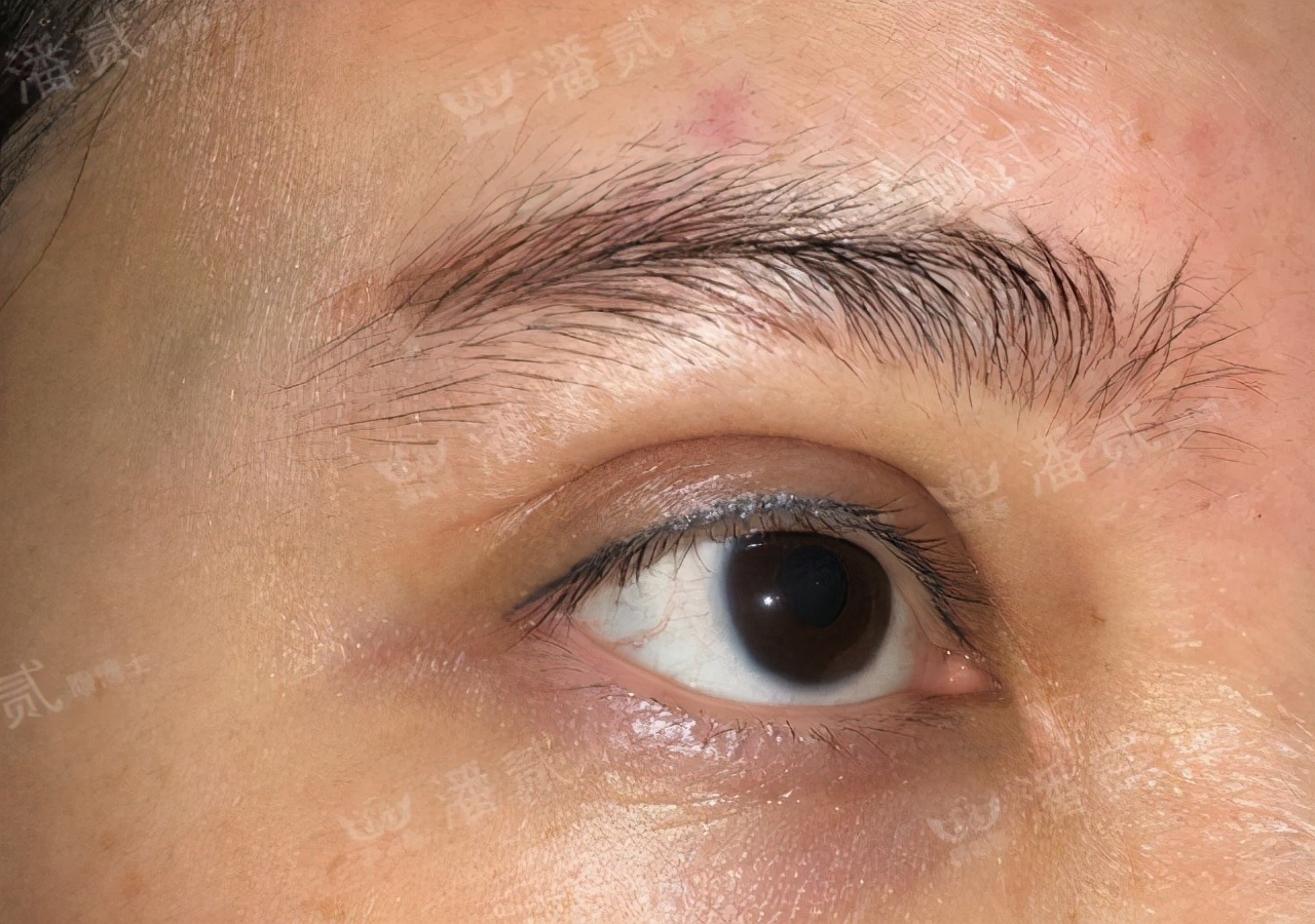自己的双眼皮太深显老怎么修复,做的双眼皮一笑有皱纹怎么修复