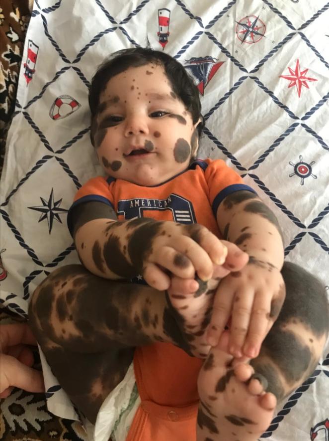 亚美尼亚男童全身布满黑色胎记，医生劝放弃，父母：他是上帝的礼物
