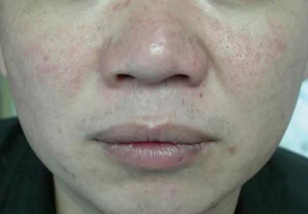 你的鼻头上有黑头怎么办,鼻尖上的黑头怎么处理