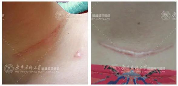 甲状腺手术后疤痕增生期是多久,甲状腺结节手术后疤痕怎样消除