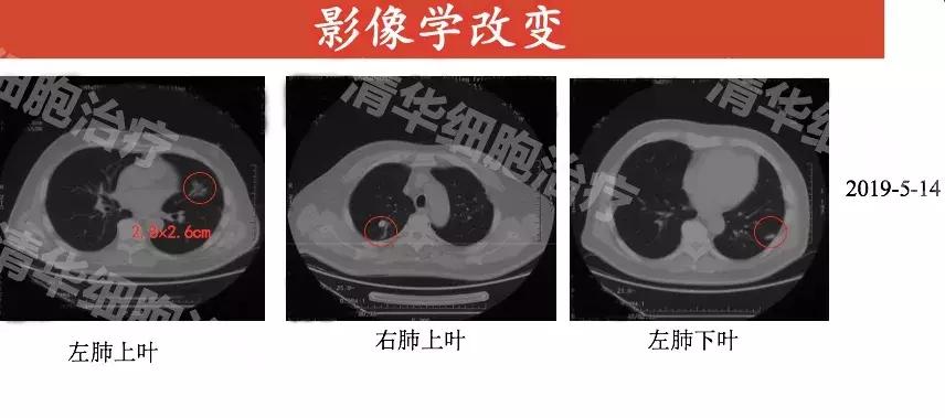 nkt免疫治疗哪些癌症,nkt癌症新疗法