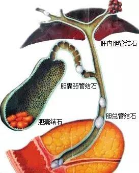 胆总管结石怎么得的,胆总管结石不疼了是掉下去了吗