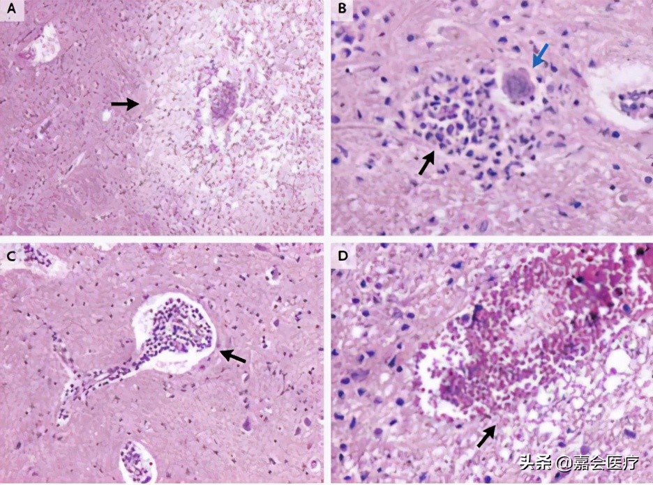 手足口病诊疗指南及解读,手足口病知识普及