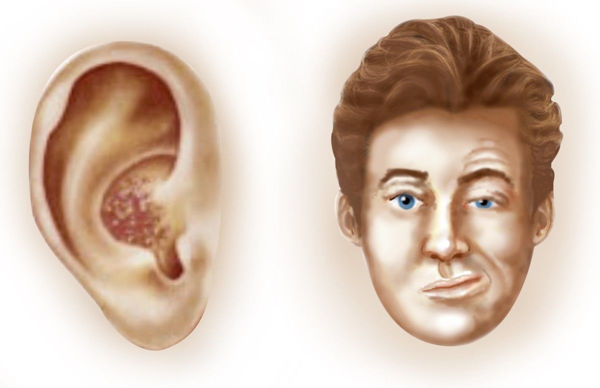 什么容易被误诊为带状疱疹,带状疱疹容易误诊吗