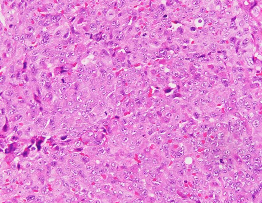 弥漫性肺泡出血能治好吗,弥漫性肺泡出血能活多久