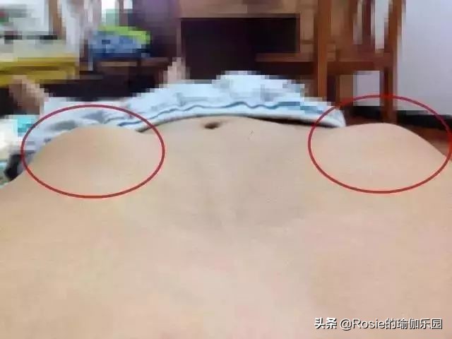 肋骨外翻怎么改善回来,肋骨外翻改善法