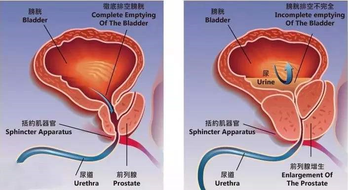 医生高空为老人吸尿,医生为前列腺病人吸尿