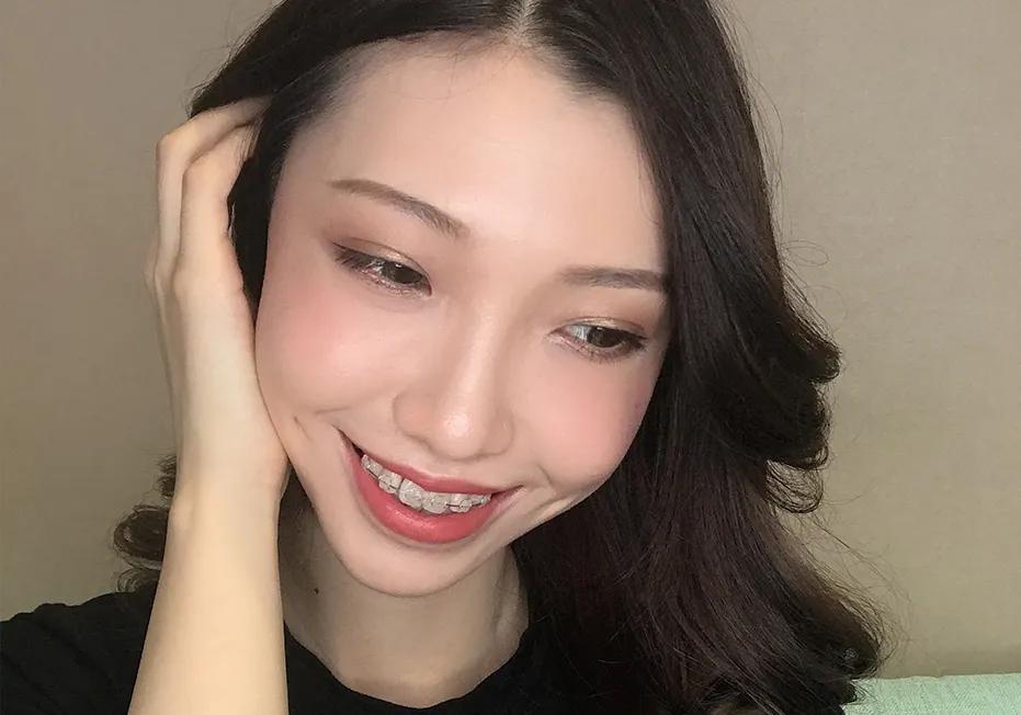 矫正牙齿详细流程,矫正牙齿所有阶段的步骤