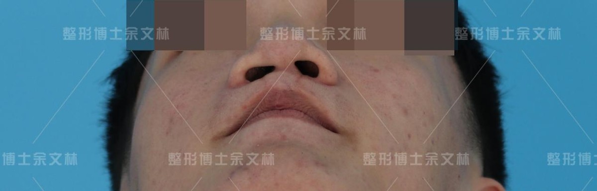 余文林博士修复唇裂多少年了,余文林唇裂二期修复大概多少钱