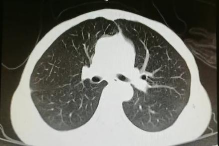 消化道出血高钾血症治疗,诊断高碳酸血症的金标准是什么