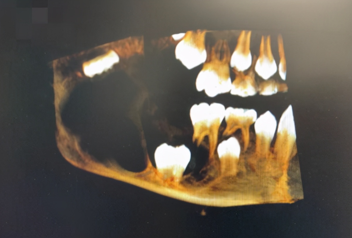 小孩嘴巴有恶性肿瘤,男童长出5斤肿瘤完整版