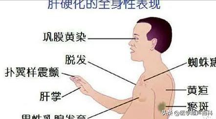 肝硬化男性乳房内硬块怎么消除,肝硬化乳房发育是什么原因