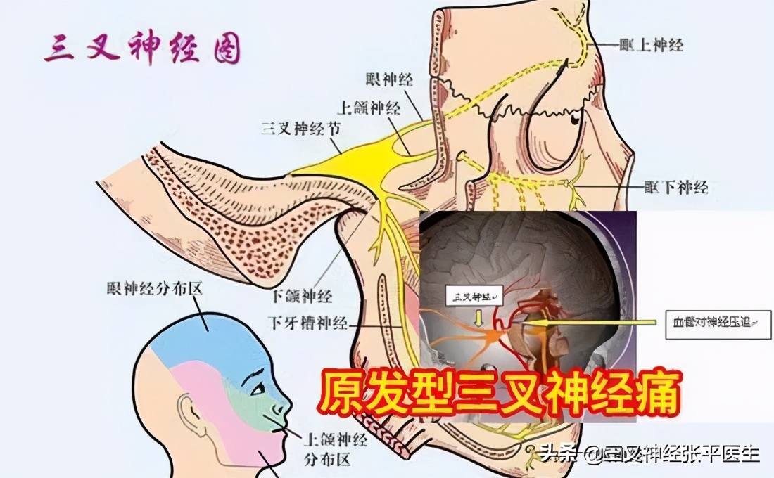 继发性三叉神经与原发性三叉神经,三叉神经痛原发性和继发性的区别