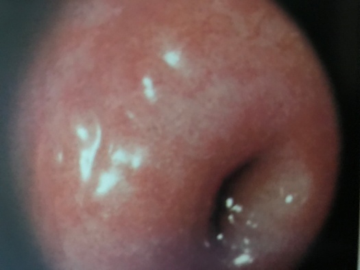 宫颈糜烂算不算病,宫颈糜烂三度算不算病