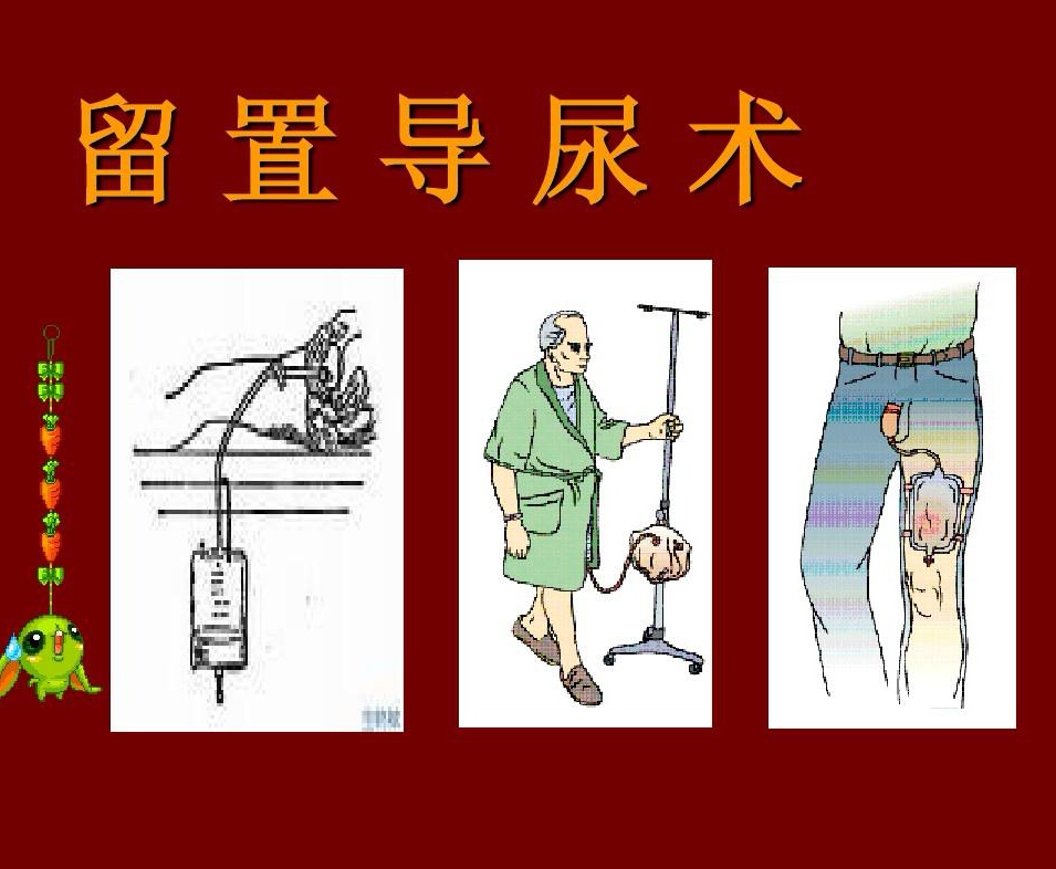 导尿管出院护理记录,留置尿管尿道口护理操作流程