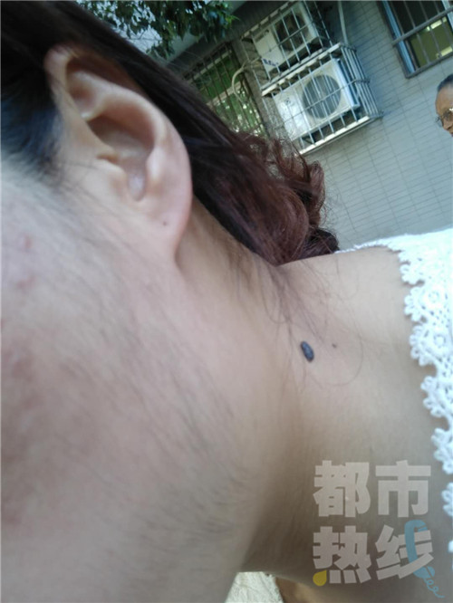 面部激光脱毛后毛发变多,女生激光脱唇毛后色素沉着