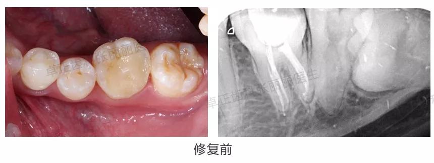 牙齿缺损全瓷冠修复多少钱,牙齿楔状缺损修复大概多少钱