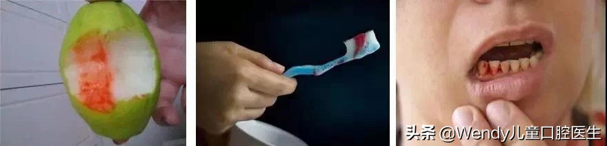 产后严重脱发吃什么钙,妈妈产后脱发严重如何自救