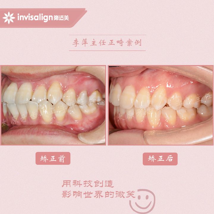 太原矫正牙齿需要做正颌吗,太原牙齿二次矫正