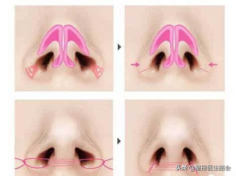 为什么有人鼻子不好看,为什么很多人鼻子不好看也很漂亮