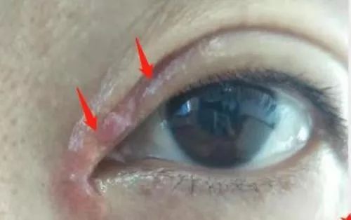 女子整容后惨不忍睹,女子双眼皮整容失败