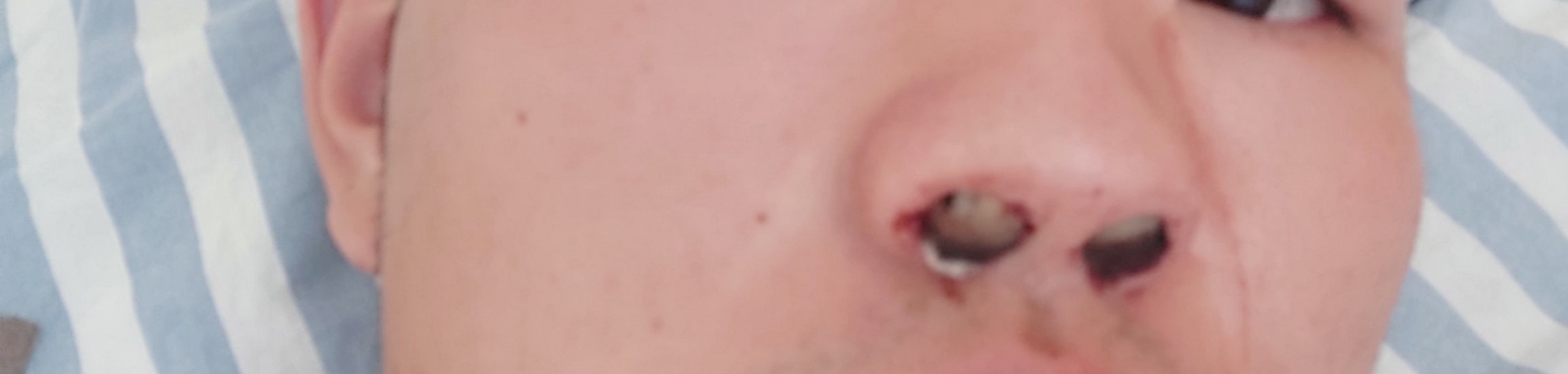 鼻窦炎患者做鼻内窥镜的经验介绍,鼻窦炎鼻息肉术后易复发吗