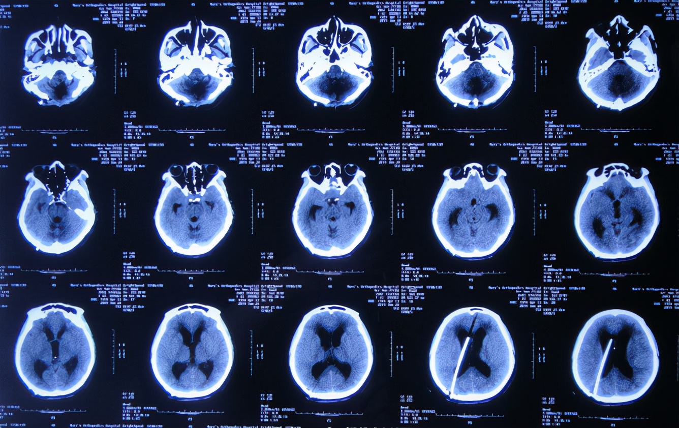 脑出血后脑积水会造成意识不清吗,脑出血后脑积水发高烧危险期多久