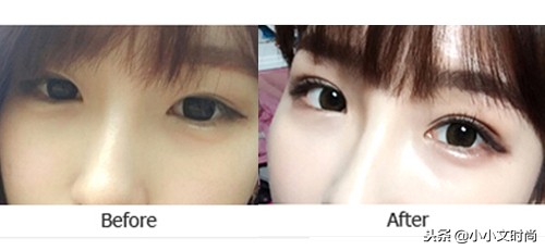 双眼皮后医生不建议用祛疤药,双眼皮手术后医生当场让看效果吗