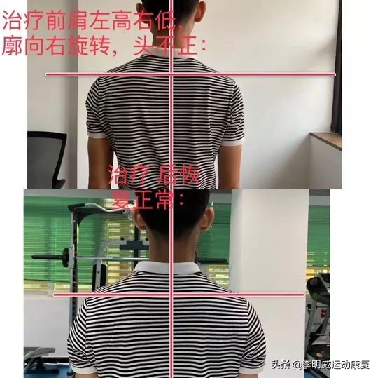 12岁孩子体态不正,体态不正导致大小脸