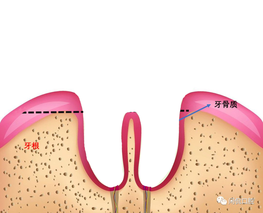 拔完牙吐了棉球还出血正常吗,拔完牙药棉拿掉出血咋办