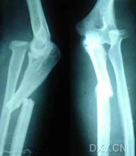 所有骨折都叫什么名字,骨折的名称有哪些