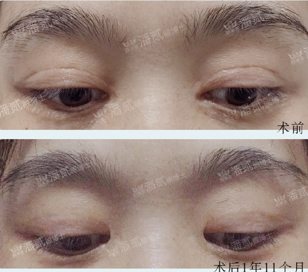 双眼皮修复有失败的吗,双眼皮修复失败了会怎样