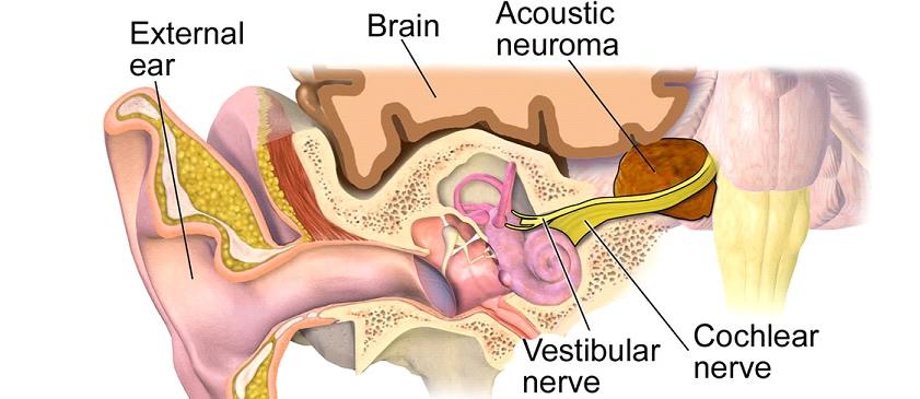 听神经瘤复发做二次手术,听神经瘤复发能要命吗