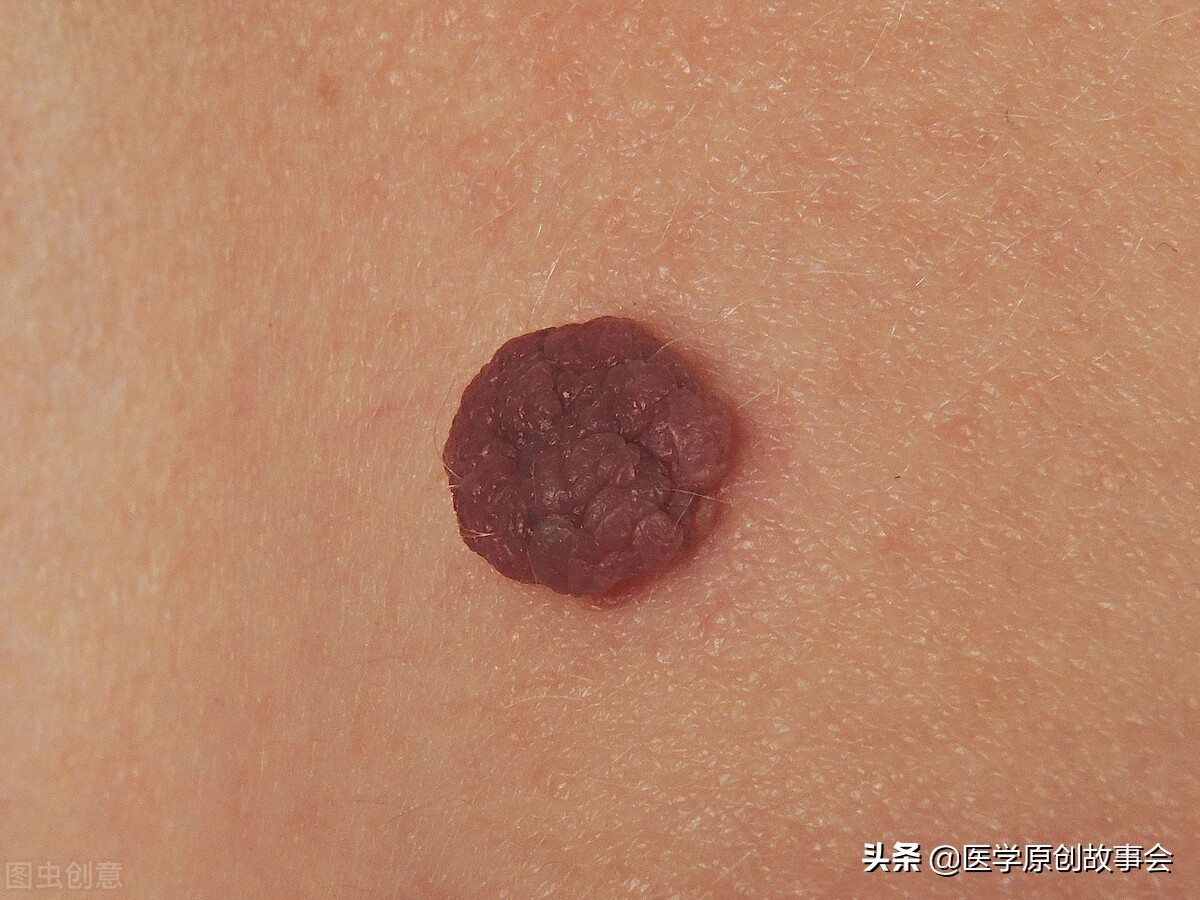 皮肤下挤出一个小肉球怎么处理,皮肤表面长出小肉球是什么原因呢