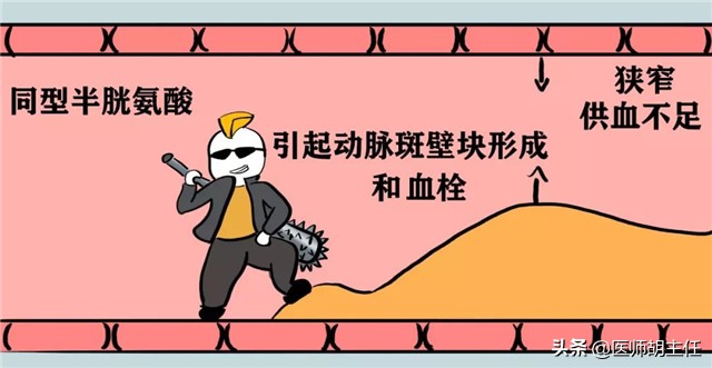 高同型半胱氨酸血症对人体的危害,同型半胱氨酸高易患什么病