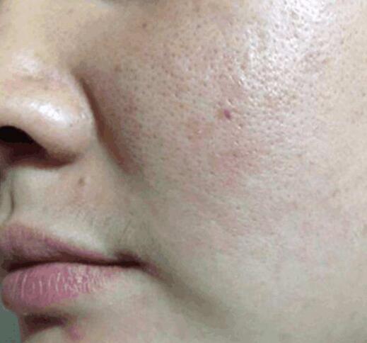 收缩毛孔最好的方法目前最有效的,收缩毛孔最简单有效的方法