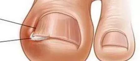 治疗甲沟炎真正有效的办法,甲沟炎指甲剪神器正品