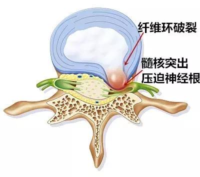 腰椎间盘突出症误区,腰椎间盘突出症的十个注意事项