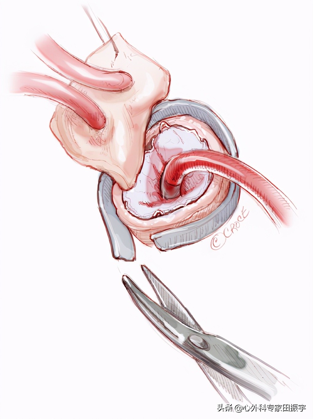 急性B型主动脉夹层合并主动脉破裂的急诊处理