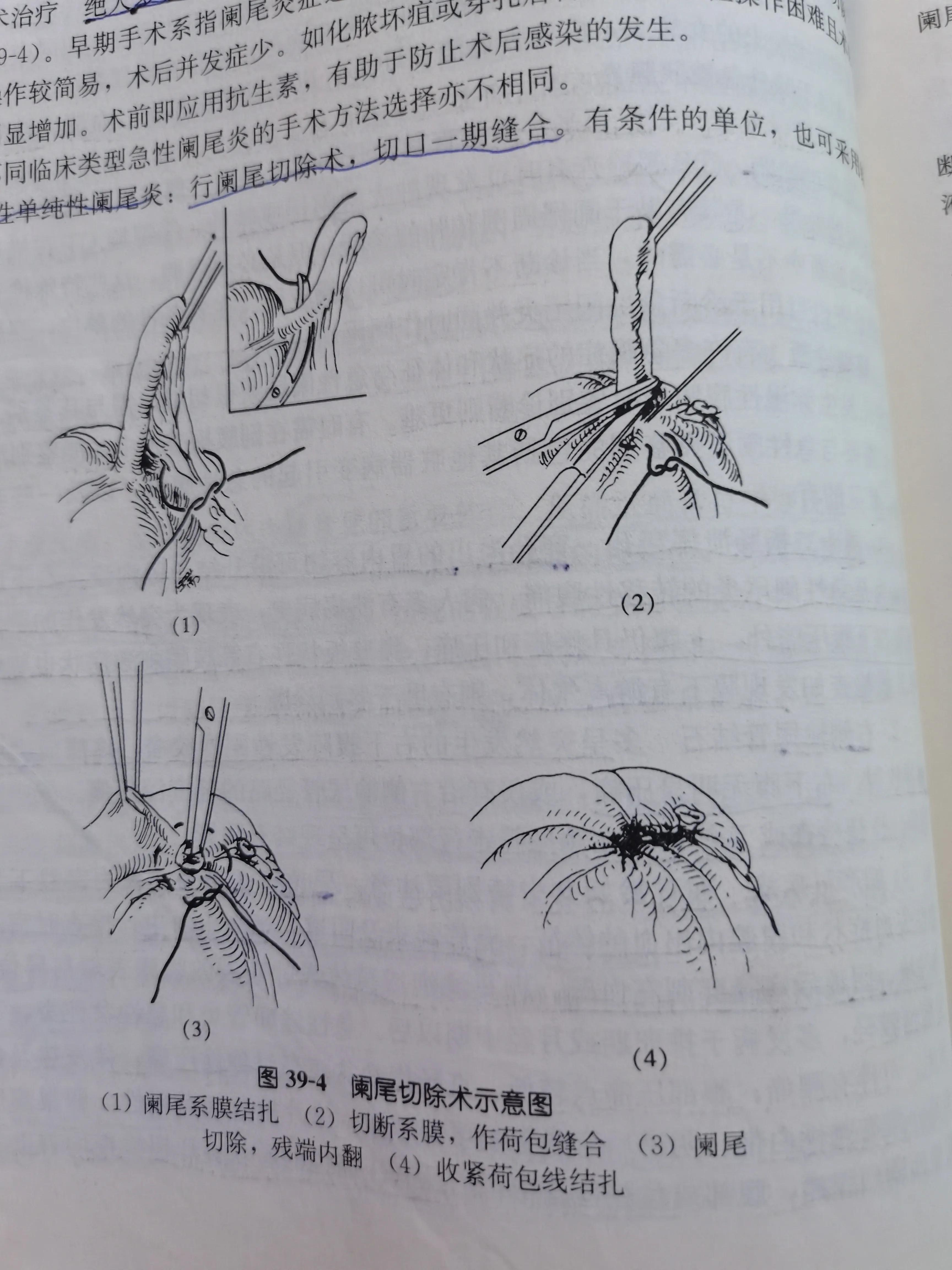 阑尾切除手术费用多少钱,阑尾切除手术记录模板